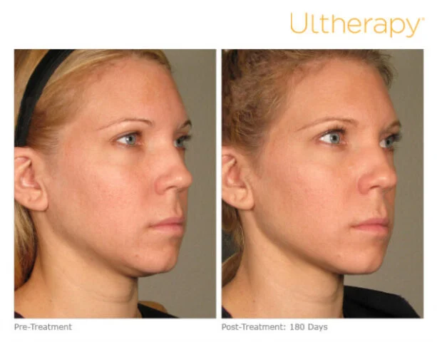 Ultherapy es un tratamiento eficaz de estiramiento facial no quirurgico